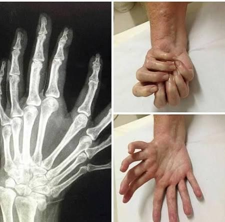 Mirror Hand Syndrome: A rare congenital condition where a hand develops with complete symmetry and no thumb.